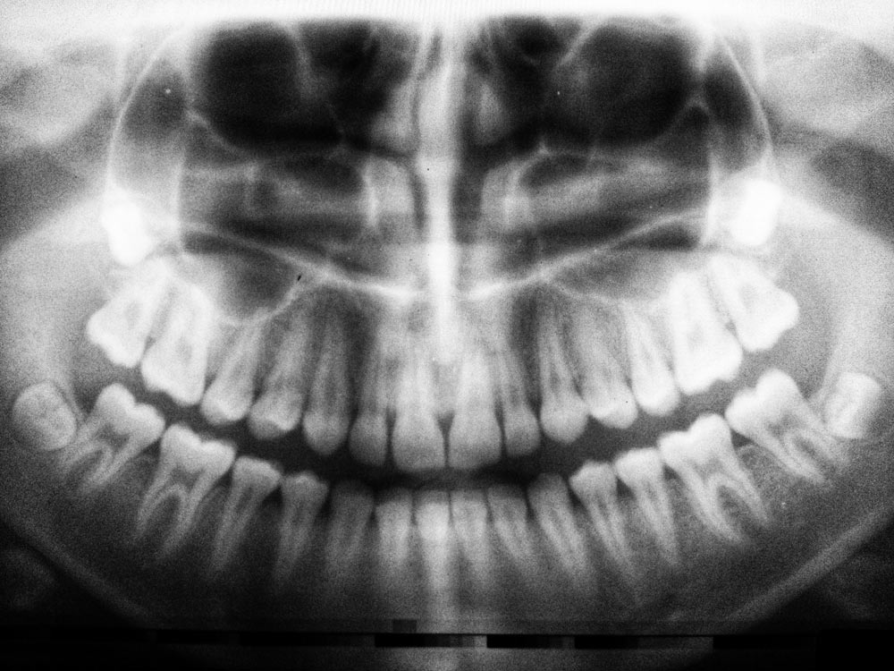 radiografia dentale