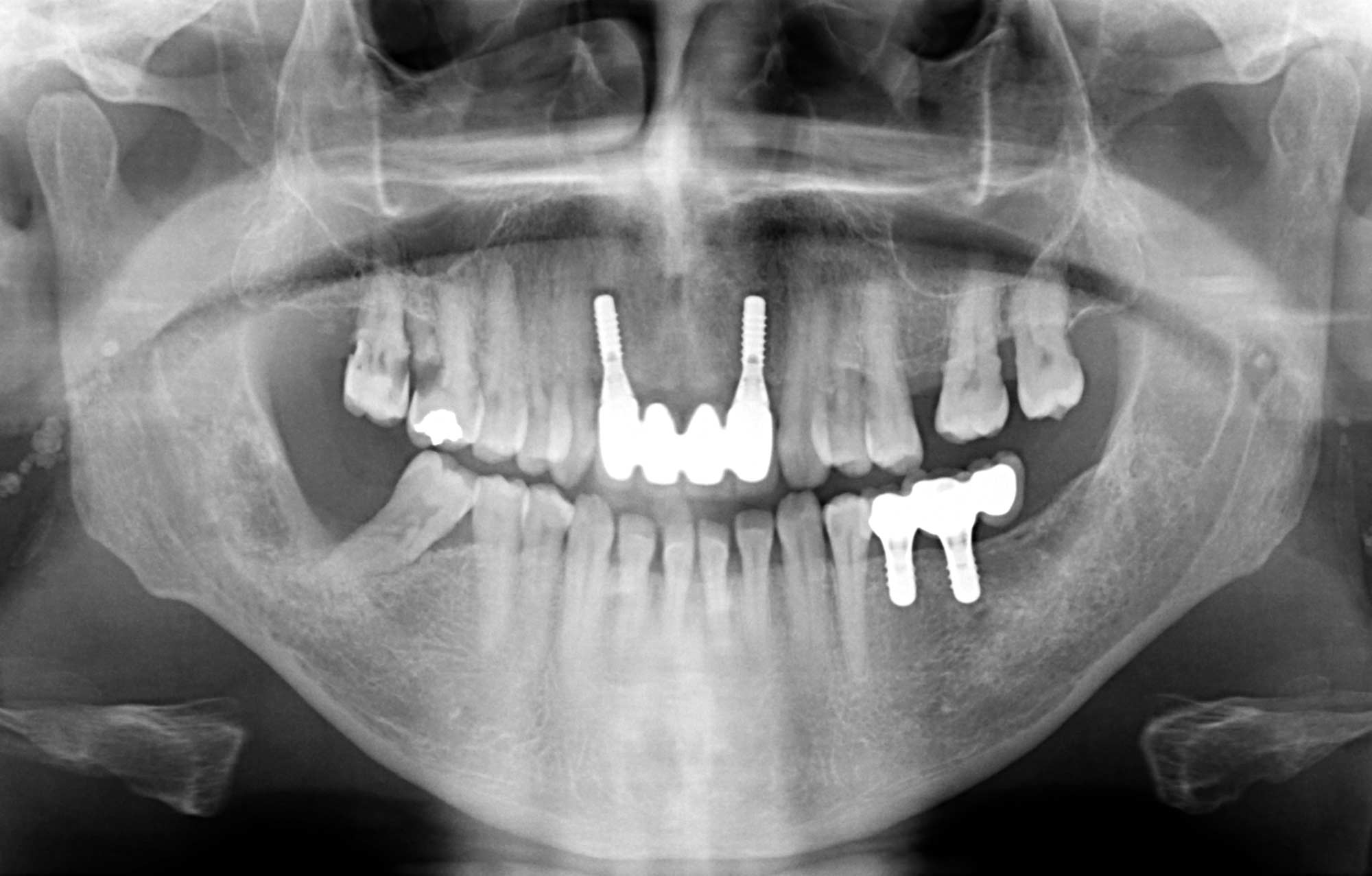 impianto dentale radiografia con protesi