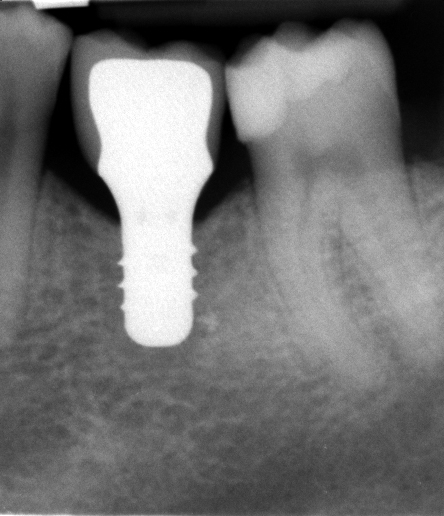 impianto dentale radiografia con protesi vista da vicino