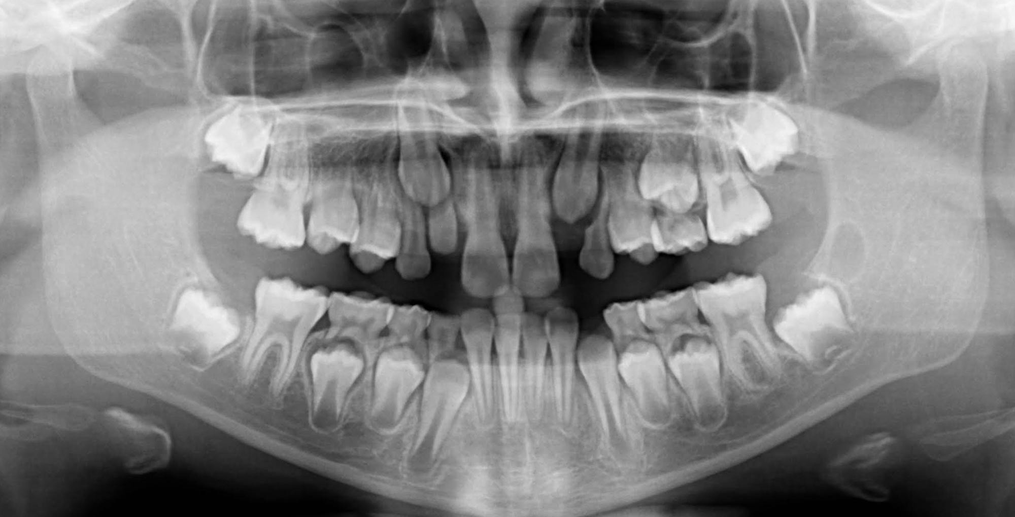 radiografia dentale bambino