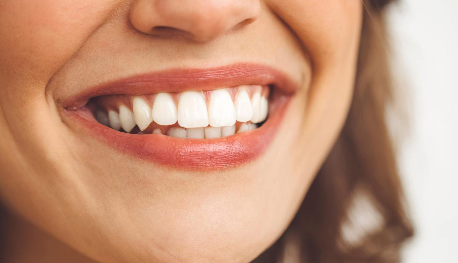 risultato denti dopo apparrecchio