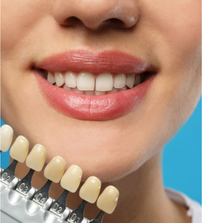 Odontoiatria_estetica campioni colore