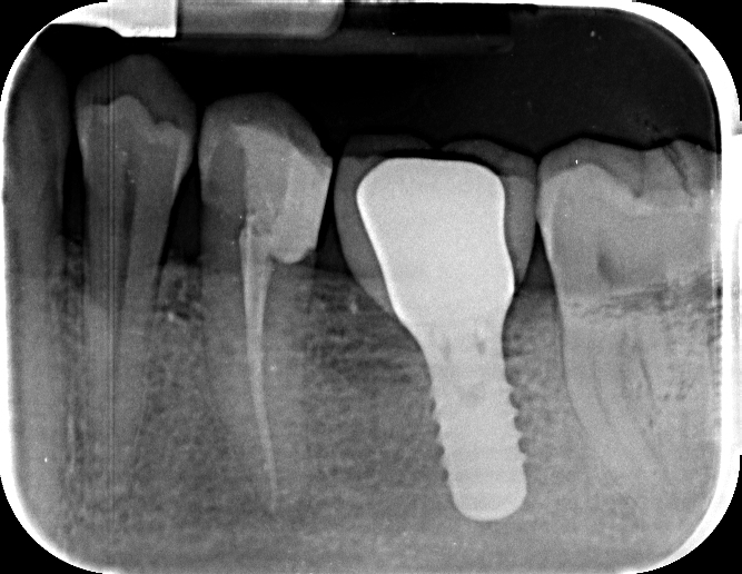 radiografia dentale con protesi