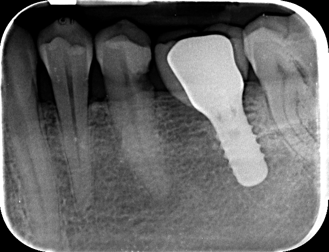 radiografia dentale con protesi
